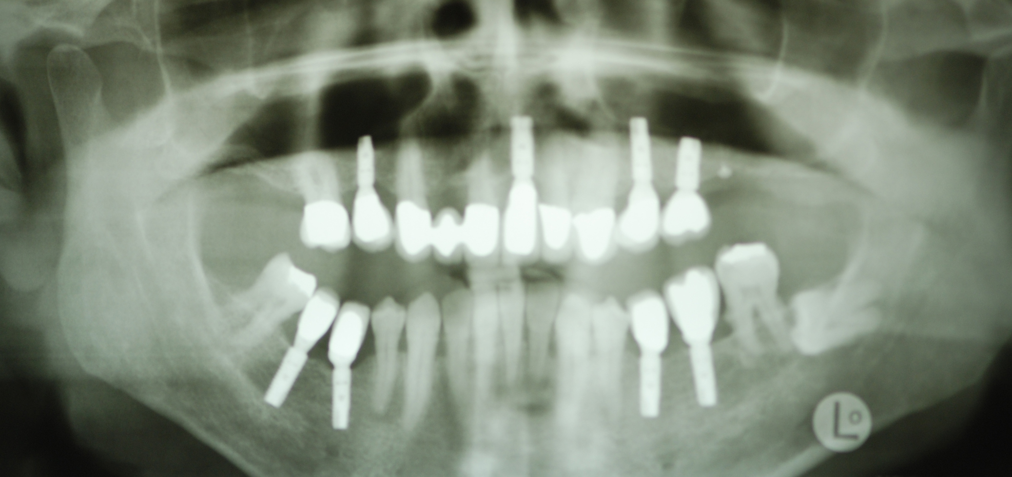 Hightech-Implantate: Direkt nach dem Setzen der Implantate Hightech-Implantate: Ansicht mit Zahnersatz nach 3 1/2 Jahren