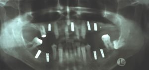Röntgenbild mit Implantaten nach Sinuslift