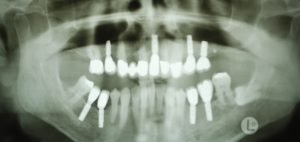 Implantate statt dritte Zähne